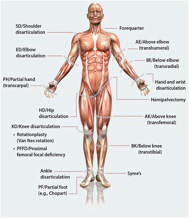 Prosthetics and Orthotics in Nerul Navi Mumbai | Shri Balaji Prosthetics